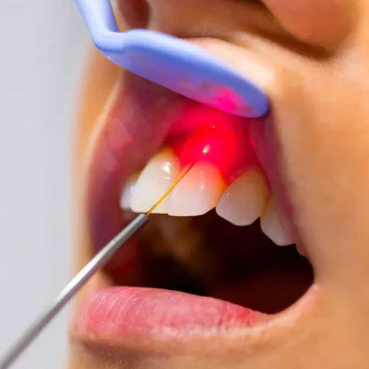 Plastie de fren labial